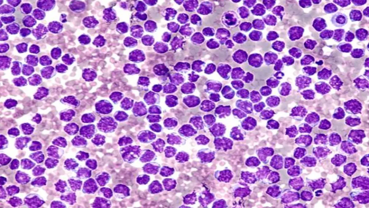 Dieses Bild zeigt eine mikroskopische Aufnahme von Zellen, die für die Diagnostik und Therapie des Mantelzell-Lymphoms typisch sind. Es illustriert den Fortschritt durch den Einsatz von Ibrutinib in der Erstlinienbehandlung.