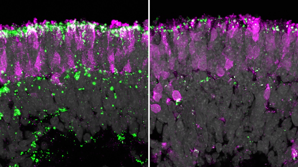 Netzhautorganoid links mit den für die CLN2-Erkrankung typischen toxischen Lipofuszinablagerungen und rechts nach der Gentherapie