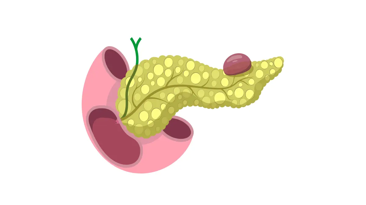 Darstellung des Konzepts der Pankreaspseudozyste mit krankheitsdiagnostischer Illustration einer Zyste des Pankreas.