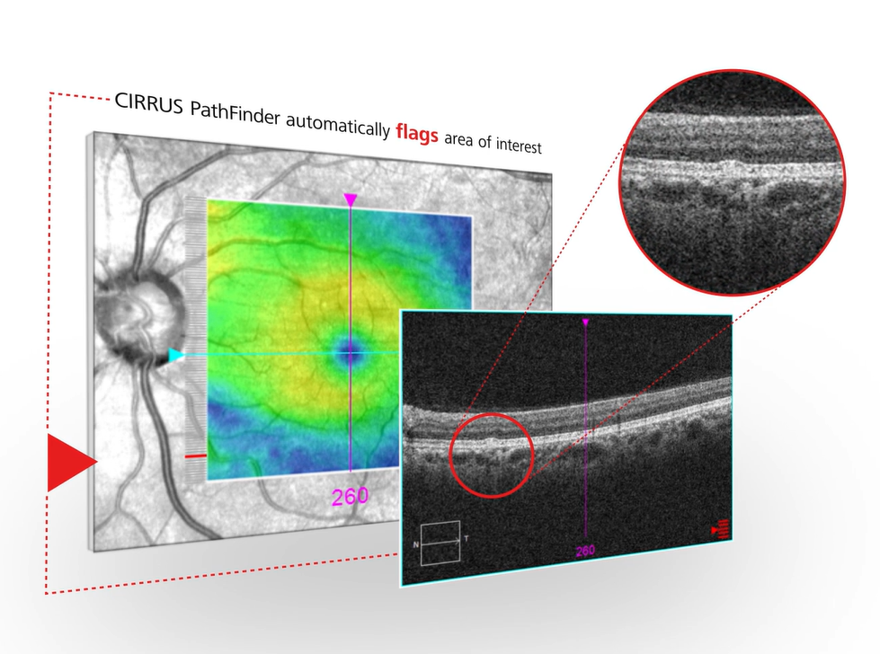 Der CIRRUS PathFinder von ZEISS hebt in OCTs Stellen hervor, die besonderer Aufmerksamkeit bedürfen. Foto: Screenshot / ZEISS.com