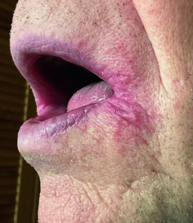 Nahaufnahme des Mundbereichs mit sichtbaren Hautproblemen vor einer Laserbehandlung.