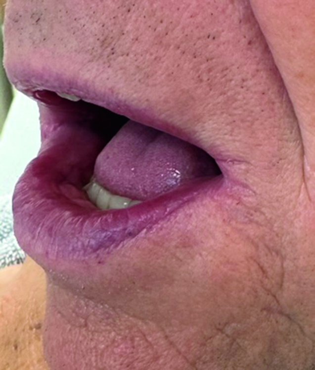 Nahaufnahme des Mundbereichs nach einer Laserbehandlung mit sichtbarer Verbesserung der Hautstruktur.