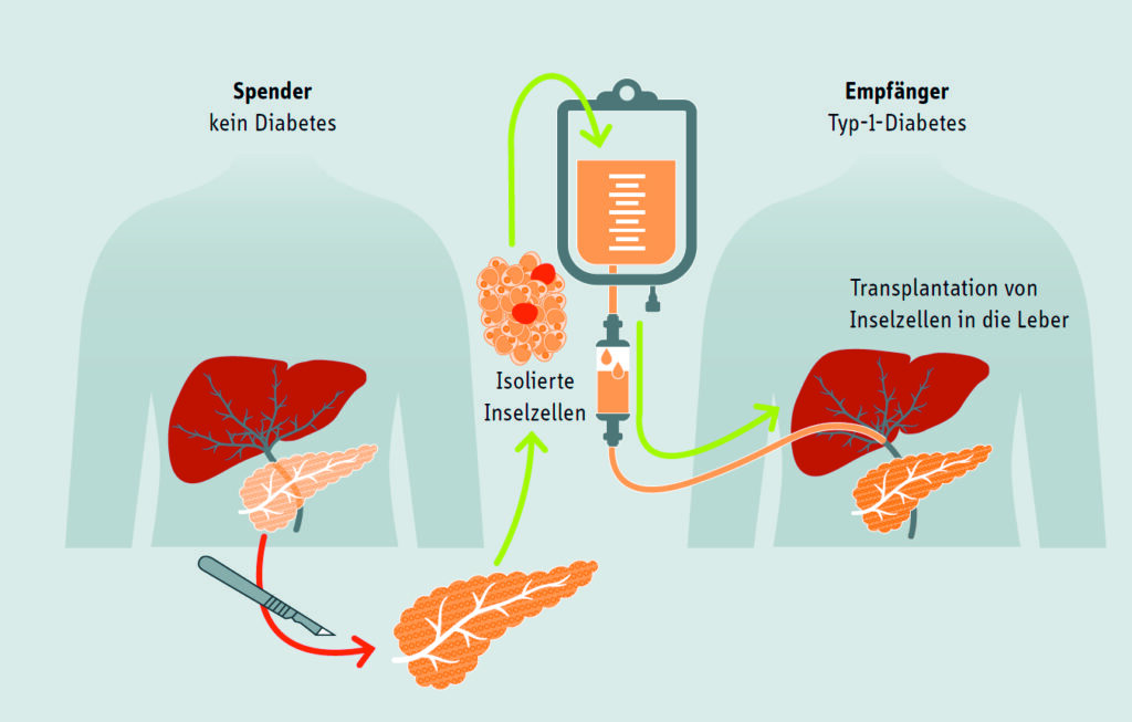 In einem mehrstufigen Verfahren werden die hormonproduzierenden Inselzellen (insbesondere Betazellen) sorgfältig aus der gesunden Spenderbauchspeicheldrüse isoliert und aufgereinigt. Nach umfassender Qualitätskontrolle werden die gewonnenen Zellcluster in die Pfortader des Empfängers eingebracht, wo sie sich in der Leber ansiedeln und dort ihre Funktion übernehmen.
© Deutsches Zentrum für Diabetesforschung (DZD)
