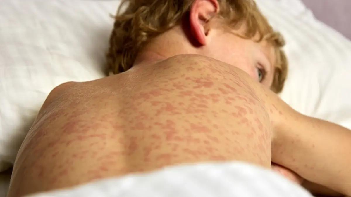 Kind mit Hautausschlag