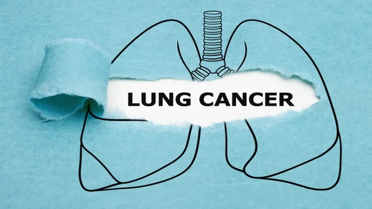 Stilisiertes Bild von Lungen mit dem Schriftzug „Lung Cancer“, symbolisiert die Diagnose und Behandlung von nicht-kleinzelligem Lungenkrebs (NSCLC).