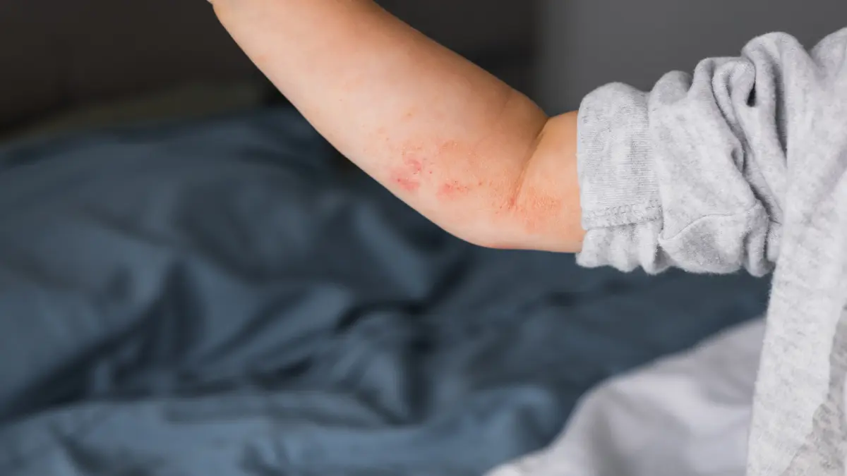 Kleine Kinderhand mit rote Flecken auf der haut