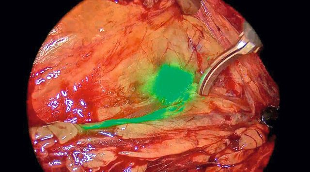 Abb. 2: Sentinel-Lymphknoten nach ICG-Anfärbung unter Infrarotkamerasicht
