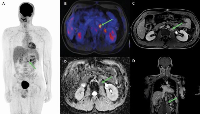 Abb. 1: Abdominales FDG-PET / MRI eines retroperitonealen Resttumors bei metastasiertem Seminom nach Chemotherapie. A: Invertierte maximale Intensitätsprojektion (MIP) eines Ganzkörper-PET / MRI mit einem paraaortalen Lymphknoten (grüner Pfeil). B: Transversale Aufnahme des abdominellen PET / MRI in Fusions­sequenz mit hoher FDG-Aufnahme aufgrund eines erhöhten Stoffwechsels (grüner Pfeil). C: Transversales Bild des abdominalen PET / MRT in T1-Sequenz mit ­hyperintensen Lymphknoten nach Kontrastmittelgabe (grüner Pfeil). D: Transversales Bild des abdominalen PET / MRI in DWI-Sequenz mit hypointensem Lymphknoten (grüner Pfeil). E: Koronares Bild in T1-Sequenz mit hyperintensen Lymphknoten nach Kontrastmittel.