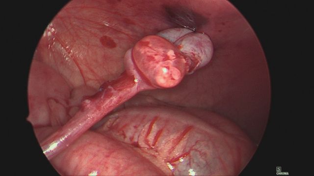 Abb. 3: Shehata-Technik: Fixation des Hodens an der kontralateralen Bauchwand im Rahmen des ersten laparoskopischen Eingriffes