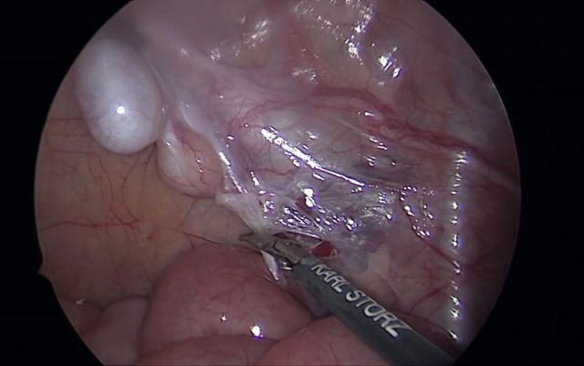Abb. 1: Fowler-Stephens-Technik (zweiter Eingriff): Durchtrennen der im Rahmen des ersten Eingriffes unterbundenen Samenstranggefäße