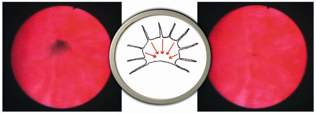 Abb. 2: Endoskopisches Bild des Sphinkter urethrae externus (leicht geöffnet links, geschlossen rechts) mit schema­tischer Darstellung zur konzentrischen Tonisierung (Mitte)