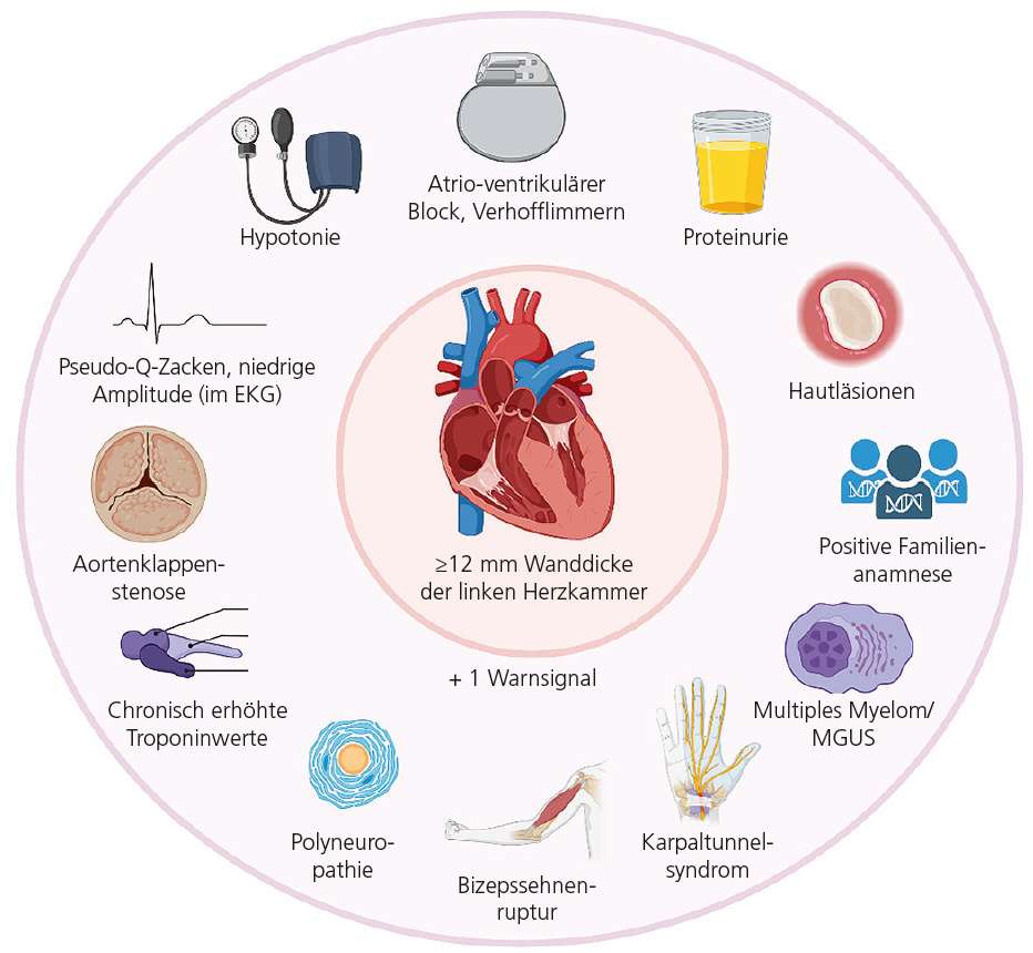 Abb. 1: Red Flags der kardialen Amyloidose.