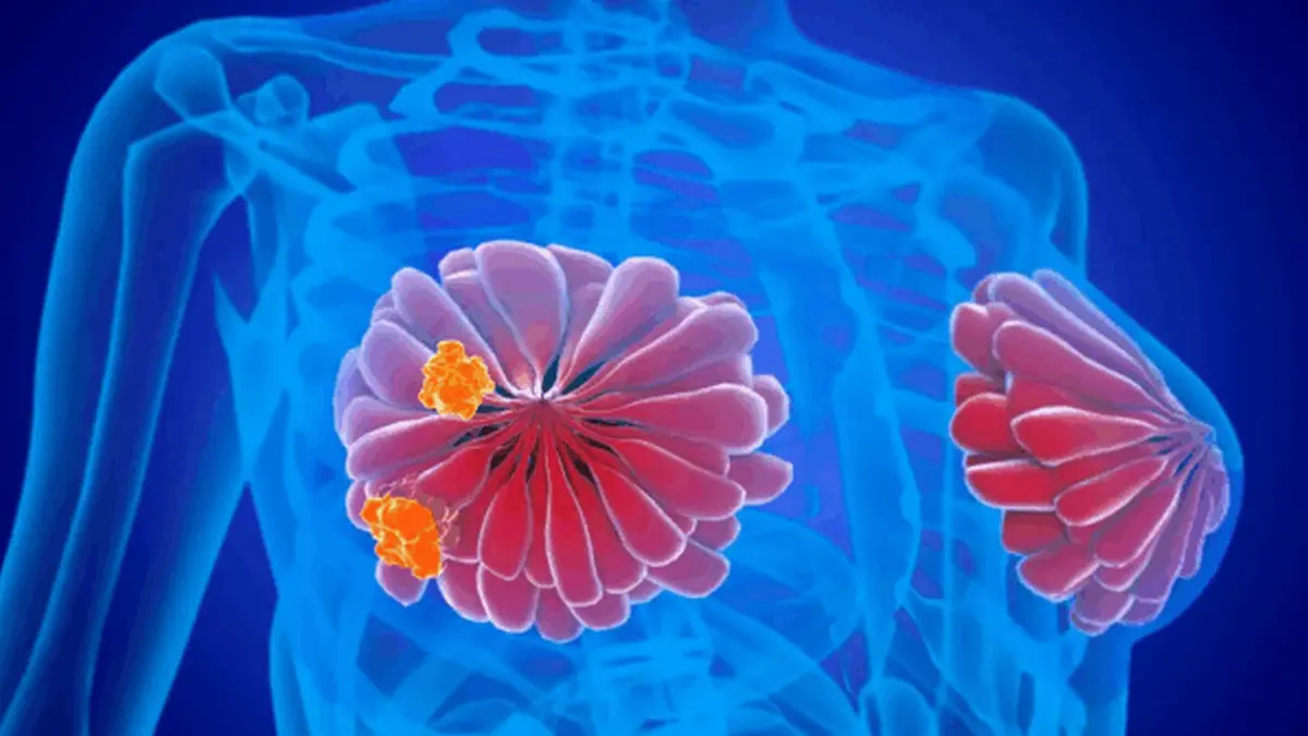 Illustration von Brustkrebszellen in der Brustdrüse, symbolisch für die Fortschritte in der personalisierten Therapie bei metastasiertem Brustkrebs.