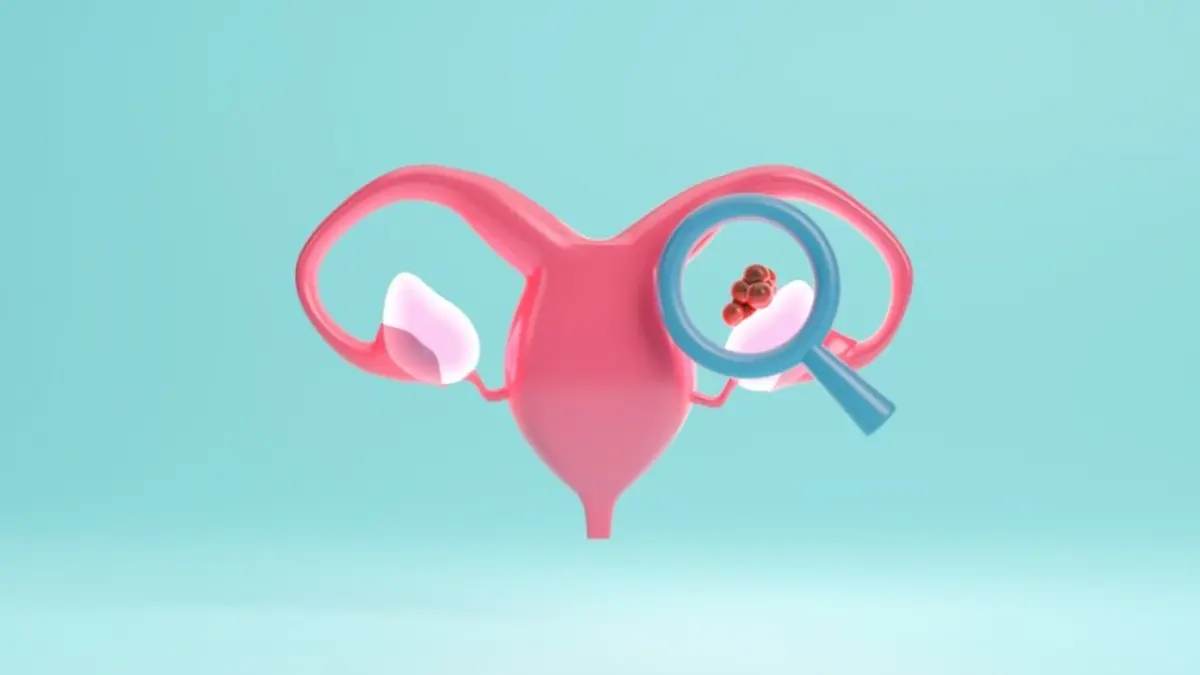 Illustration des weiblichen Fortpflanzungssystems mit hervorgehobenen Tumorzellen, symbolisch für die Fortschritte in der Therapie des Ovarialkarzinoms.