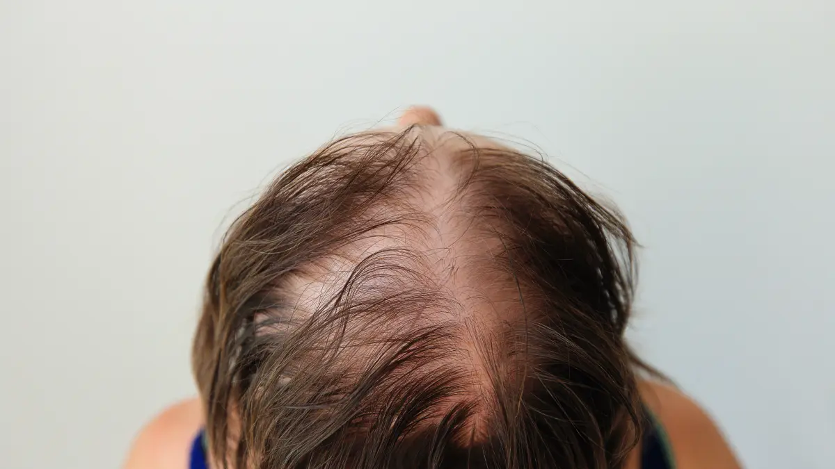 Nahaufnahme von Haarverlust, typisch für Alopecia Areata, symbolisiert die Verbindung zwischen Haut- und Darmerkrankungen.