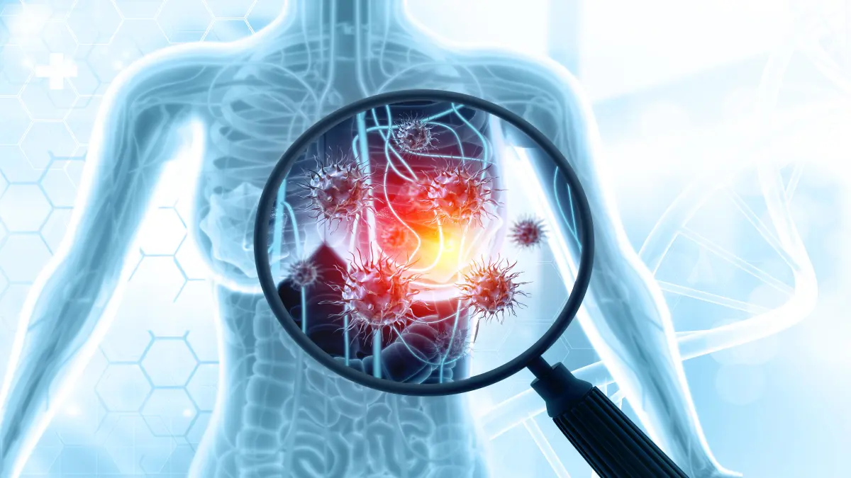 Illustration von Brustkrebszellen unter einer Lupe, hervorgehoben durch rote und gelbe Farben.