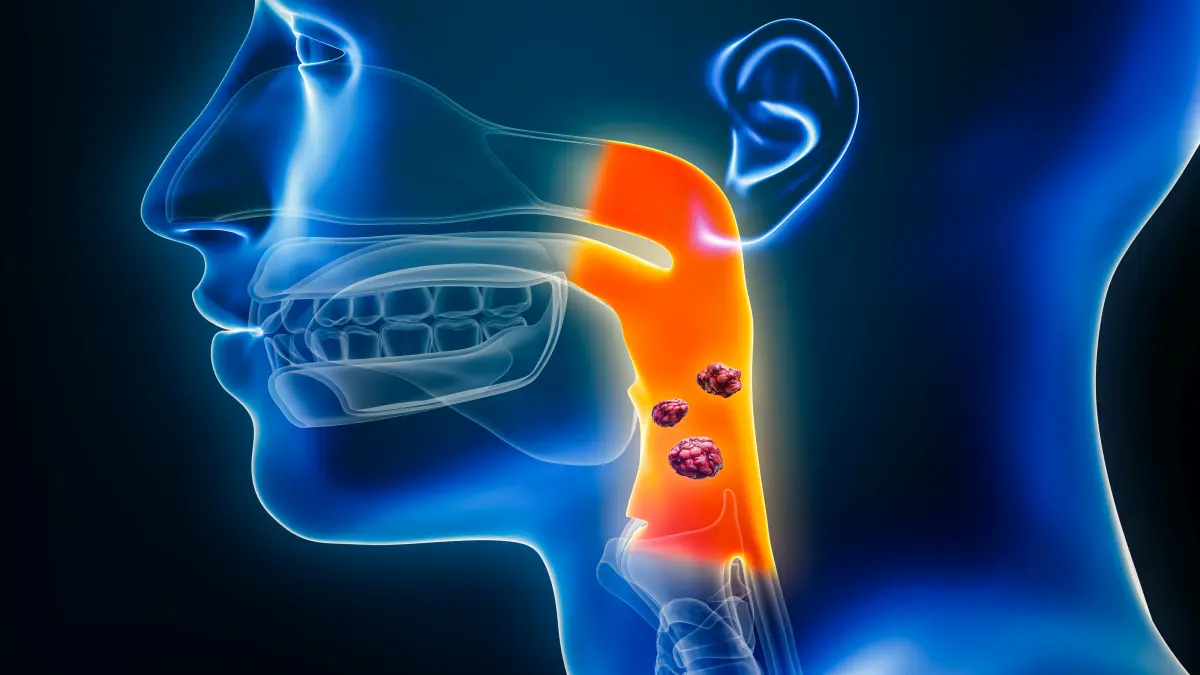 Darstellung eines Oropharynxkarzinoms, das durch eine HPV-Infektion verursacht wurde.