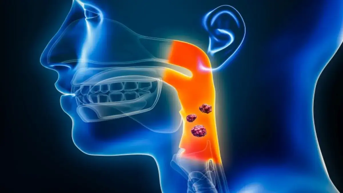 3D-Darstellung eines Kopf-Hals-Tumors im menschlichen Hals und Rachen
