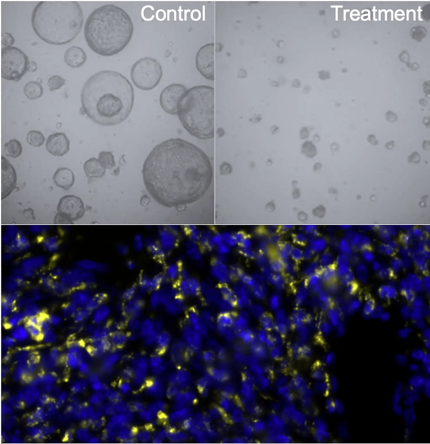 Mini-Tumormodelle aus Patientengewebe (Organoide) ohne und mit Behandlung, sowie Tumor mit Makrophagen.