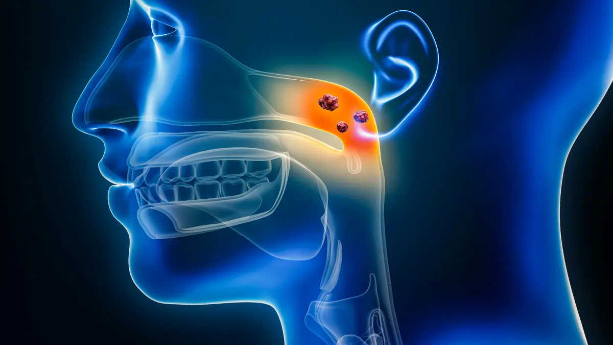 Illustration des Nasopharynxkarzinoms mit hervorgehobenen Tumorzellen im Nasen-Rachen-Bereich.