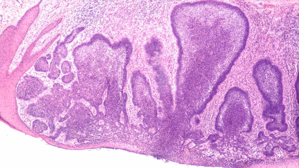 Mikroskopische Aufnahme von Hautzellen, die für die Diagnostik und Prävention von Hautkrebs, insbesondere cSCC und Basalzellkarzinomen, relevant sind.