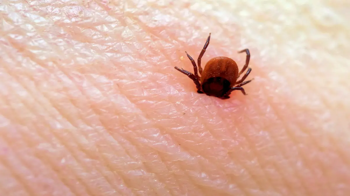 Nahaufnahme einer Zecke auf menschlicher Haut, symbolisiert zecken-assoziierte neurologische Erkrankungen wie FSME und Borreliose.